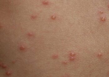 Argentina reportó su primer caso sospechoso de viruela del mono